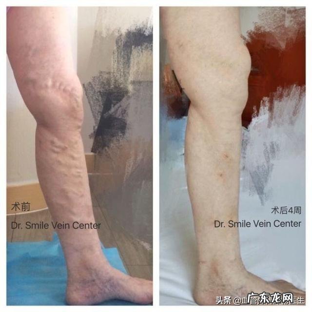 老年人的静脉曲张腿肿痛,怎样才可以缓解呢?