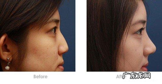 做完隆鼻怎么快速消肿 隆鼻术如何快速消肿