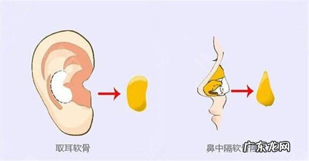 做完隆鼻怎么快速消肿 隆鼻术如何快速消肿