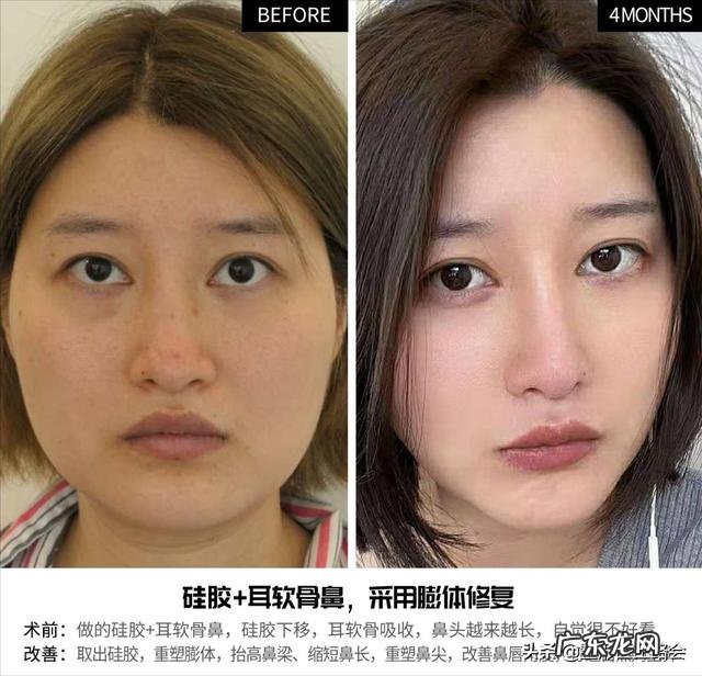 整鼻子哪个医院靠谱 做鼻子到哪个医院比较靠谱