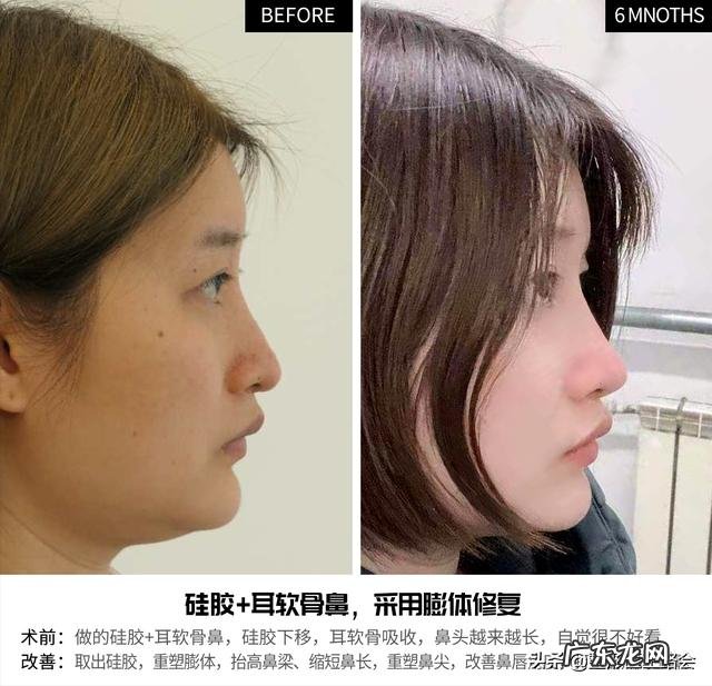 整鼻子哪个医院靠谱 做鼻子到哪个医院比较靠谱