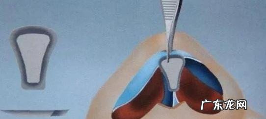 隆鼻最佳方法图解 隆鼻尖用什么方法好