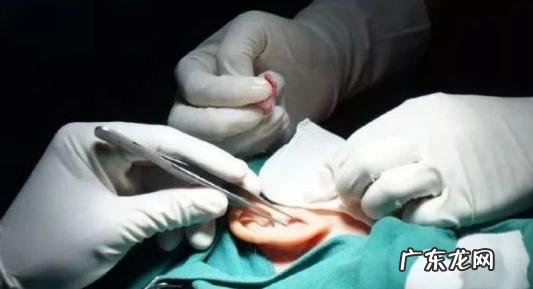 隆鼻最佳方法图解 隆鼻尖用什么方法好