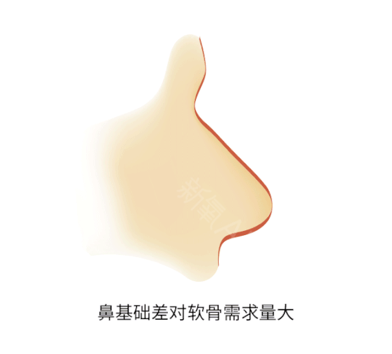 自己做肋软骨隆鼻需要多少钱 用自身的肋软骨隆鼻多少钱