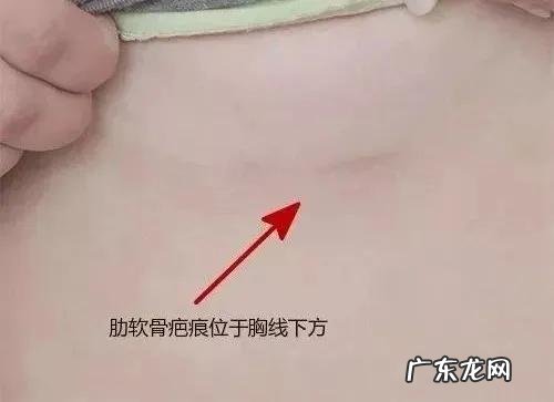 自己做肋软骨隆鼻需要多少钱 用自身的肋软骨隆鼻多少钱