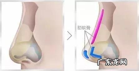 自己做肋软骨隆鼻需要多少钱 用自身的肋软骨隆鼻多少钱