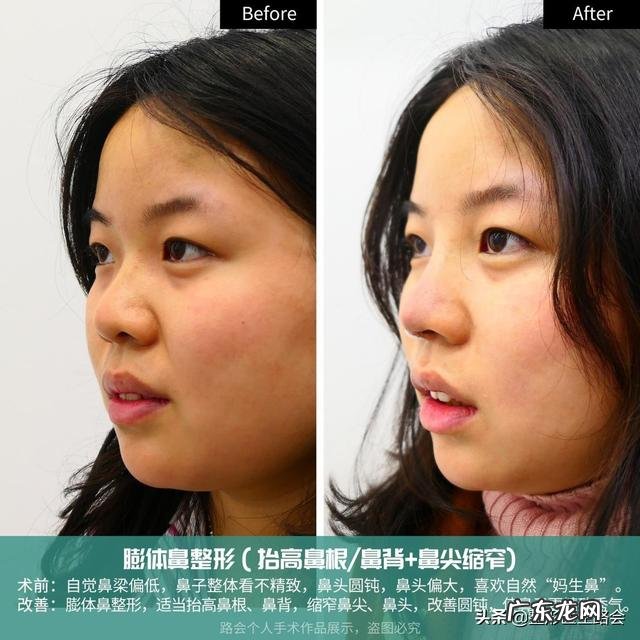上海九院现在还有假体隆鼻吗 上海九院隆鼻面诊后能直接手术吗