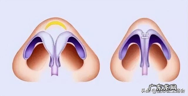 上海九院现在还有假体隆鼻吗 上海九院隆鼻面诊后能直接手术吗