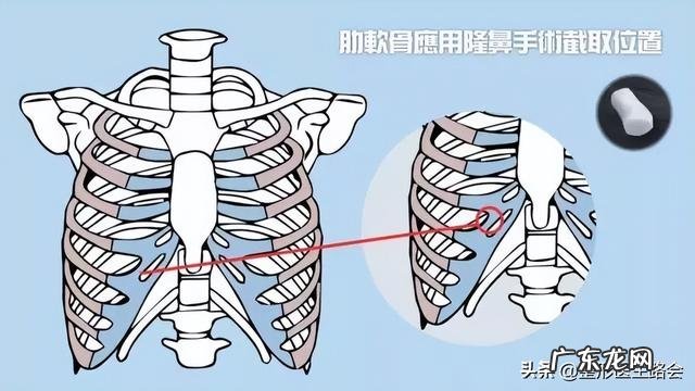 上海九院现在还有假体隆鼻吗 上海九院隆鼻面诊后能直接手术吗