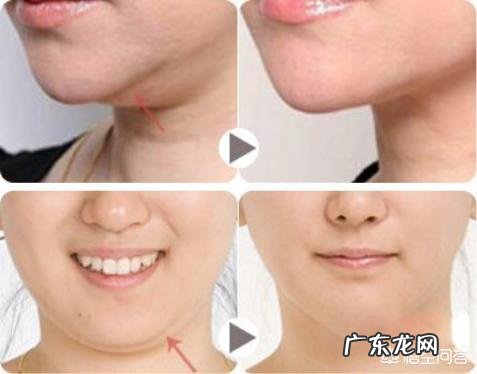 吸脂可以减肥吗?吸脂瘦下来的原理是什么?