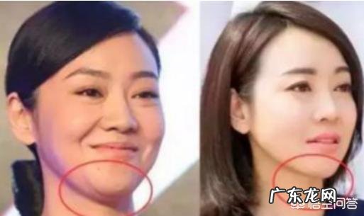 吸脂可以减肥吗?吸脂瘦下来的原理是什么?