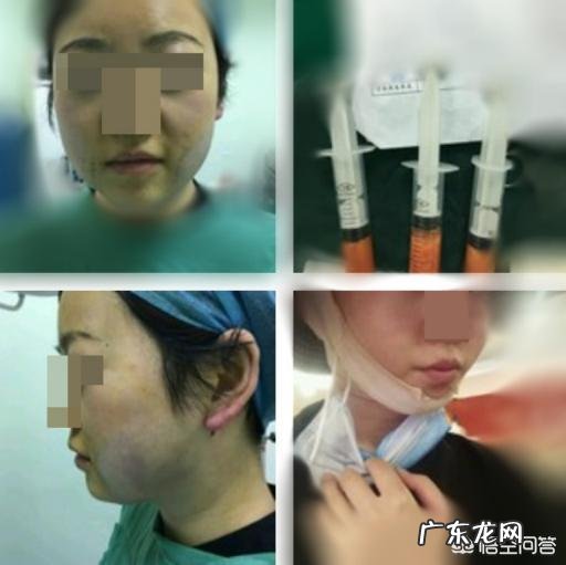 吸脂可以减肥吗?吸脂瘦下来的原理是什么?