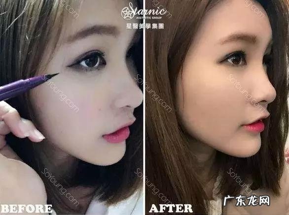 张馨予鼻子是谁做的 张馨予隆鼻