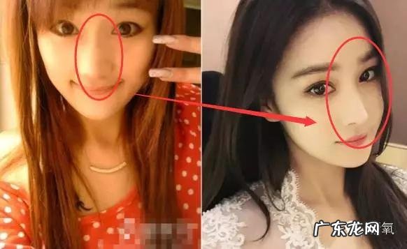 张馨予鼻子是谁做的 张馨予隆鼻