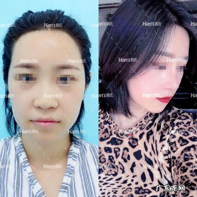 隆鼻后为什么会越来越丑 为什么做了隆鼻的人越来越多