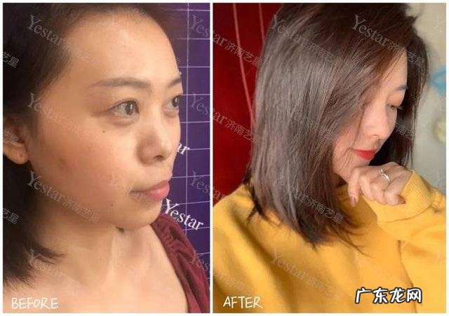 明星都怎么隆鼻 明星隆鼻为什么没有疤痕