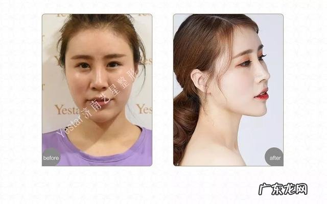 假体隆鼻手术安全吗 假体隆鼻透光算不算手术失败