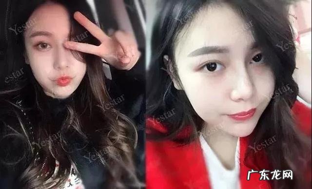 假体隆鼻手术安全吗 假体隆鼻透光算不算手术失败