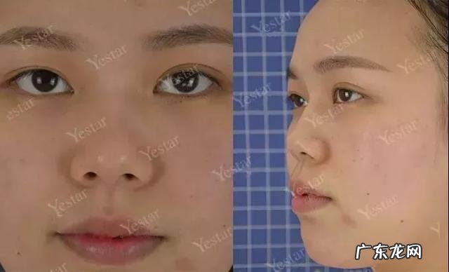 假体隆鼻手术安全吗 假体隆鼻透光算不算手术失败