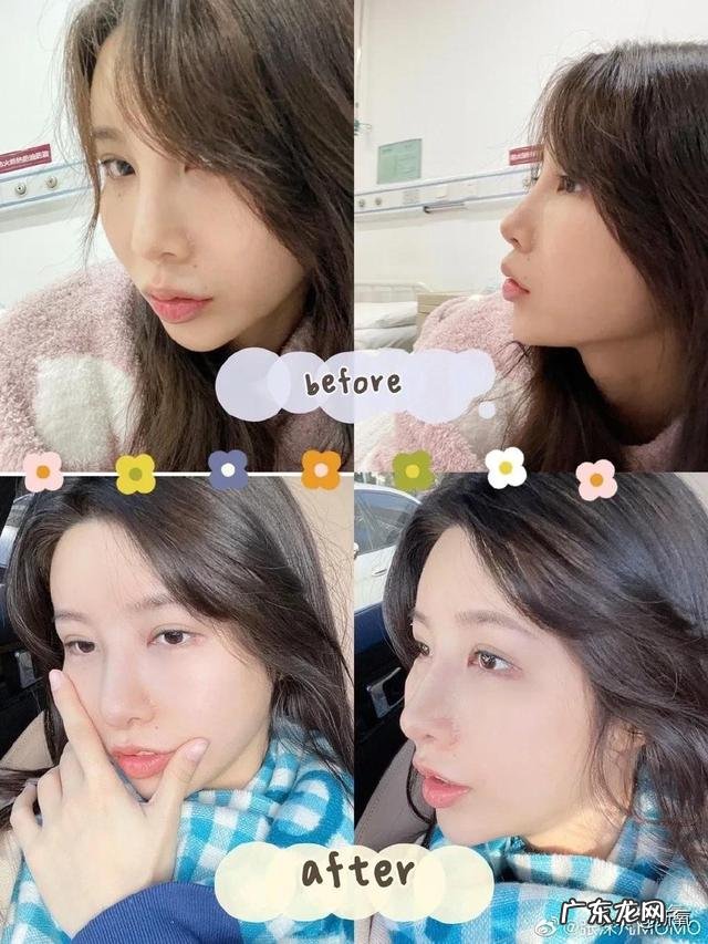 张沫凡小姐姐的鼻子整容过程 网红怎么p鼻子