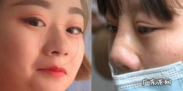 隆鼻不成功怎么修复 女子隆鼻失败修复