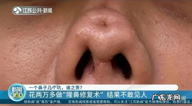 隆鼻后鼻梁处有凹陷是怎么回事 女主播隆鼻手术后鼻子凹陷