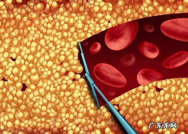 血脂过高,脸部有两种异常表现,提示该降血脂了,避免更大问题