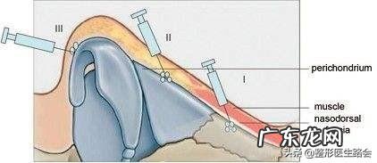 哪种隆鼻材料受欢迎 哪种隆鼻材料比较好