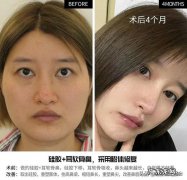 耳软骨隆鼻多久后自然 耳软骨隆鼻鼻尖多久吸收得自然