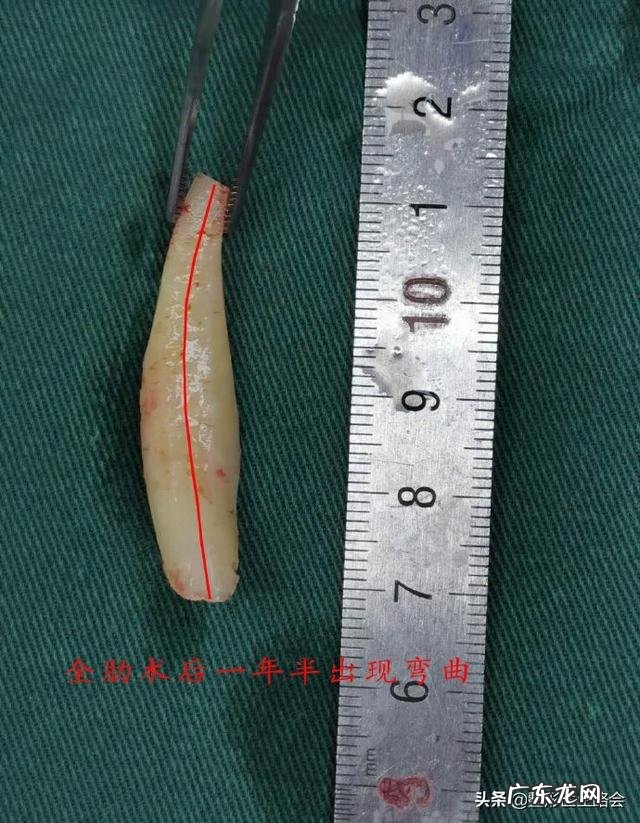 耳软骨隆鼻多久后自然 耳软骨隆鼻鼻尖多久吸收得自然