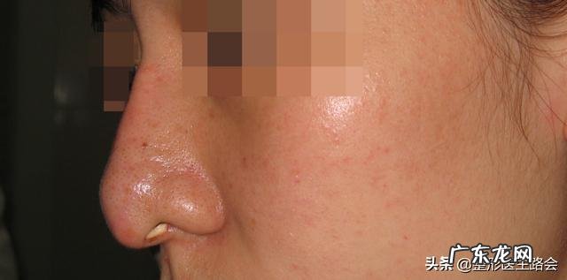 耳软骨隆鼻多久后自然 耳软骨隆鼻鼻尖多久吸收得自然