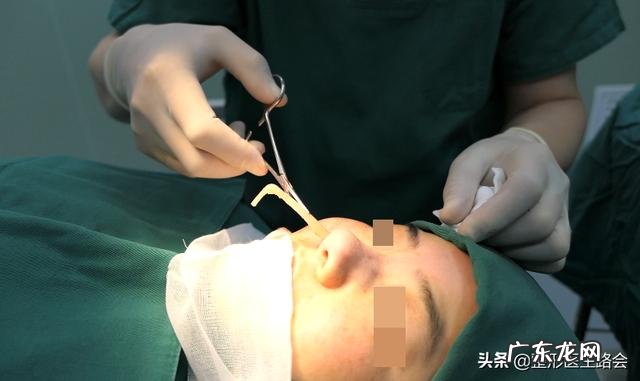 耳软骨隆鼻多久后自然 耳软骨隆鼻鼻尖多久吸收得自然