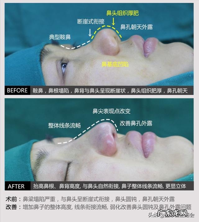 耳软骨隆鼻多久后自然 耳软骨隆鼻鼻尖多久吸收得自然