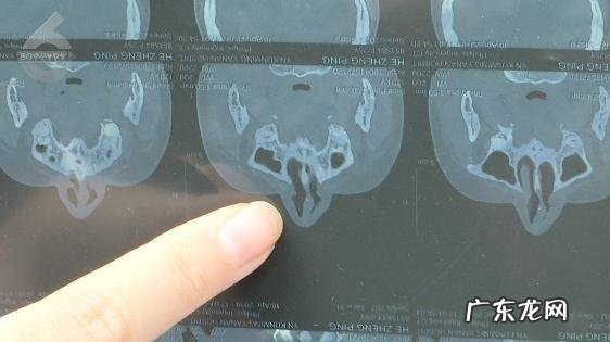 昆明哪家隆鼻术好 昆明隆鼻哪家比较好