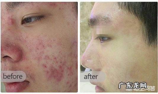 吃什么水果可以祛痘?如何才能护肤?