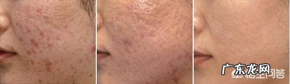 吃什么水果可以祛痘?如何才能护肤?