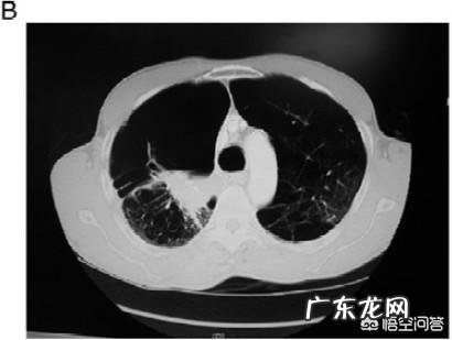 慢性阻塞性肺疾病,您了解吗?