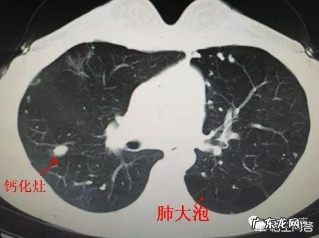 慢性阻塞性肺疾病,您了解吗?