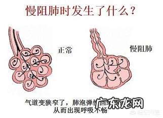 慢性阻塞性肺疾病真的有那么严重吗?应该如何正确预防?