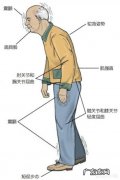 得帕金森这种病到最后会有什么现象