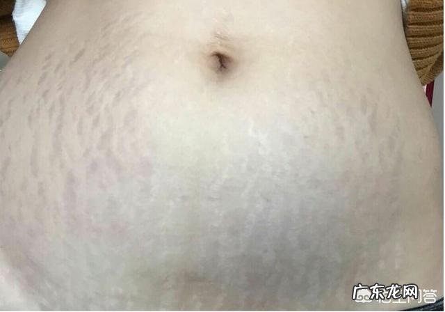 怎样预防妊娠纹？产后妊娠纹该怎么消除？