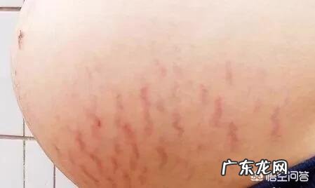 怎样预防妊娠纹？产后妊娠纹该怎么消除？