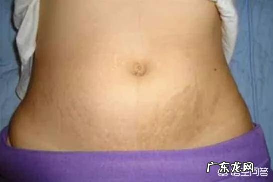 怎样预防妊娠纹？产后妊娠纹该怎么消除？