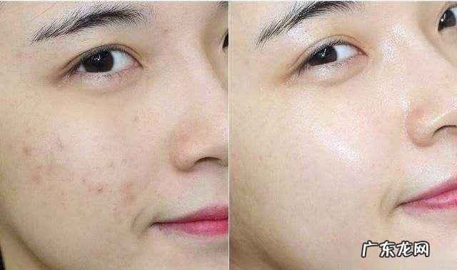 使用同款护肤品,皮肤却没有别人好,以下4条症状说明毛孔堵塞了