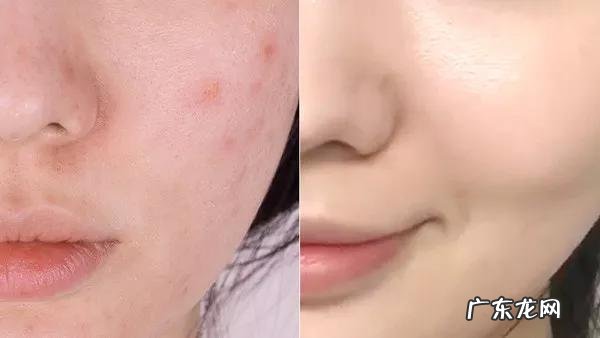 使用同款护肤品,皮肤却没有别人好,以下4条症状说明毛孔堵塞了