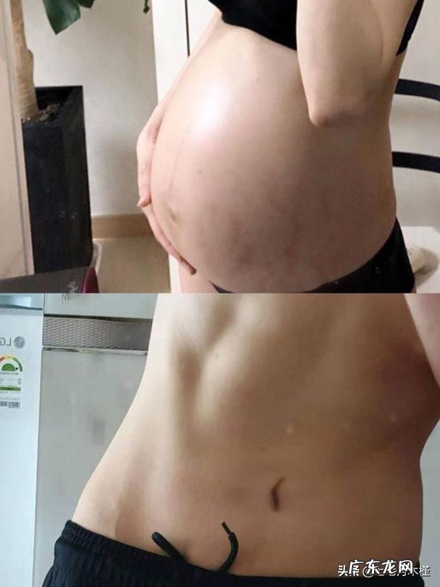 女人产后如何彻底去除妊娠纹?