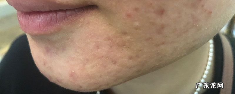 脸上的毛孔里有白色的脏东西怎么办?