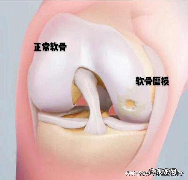 几个月前因为运动过度，导致膝关节疼痛，为什么不跑就不会疼了