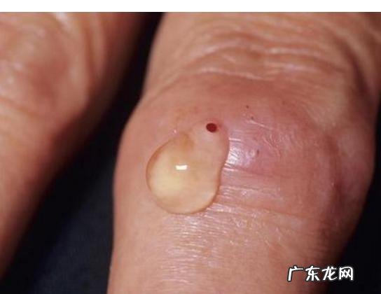 有没有比薏米祛湿好100倍的食物？