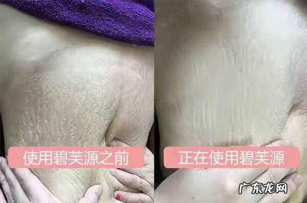 变瘦之后的妊娠纹或生长纹可以通过什么方法去除?